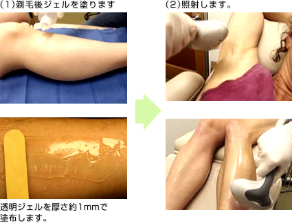 脱毛 愛知